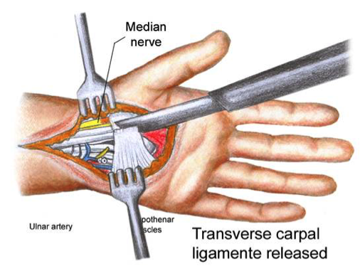 Carpal Tunnel Surgery Video The Carpal Solution