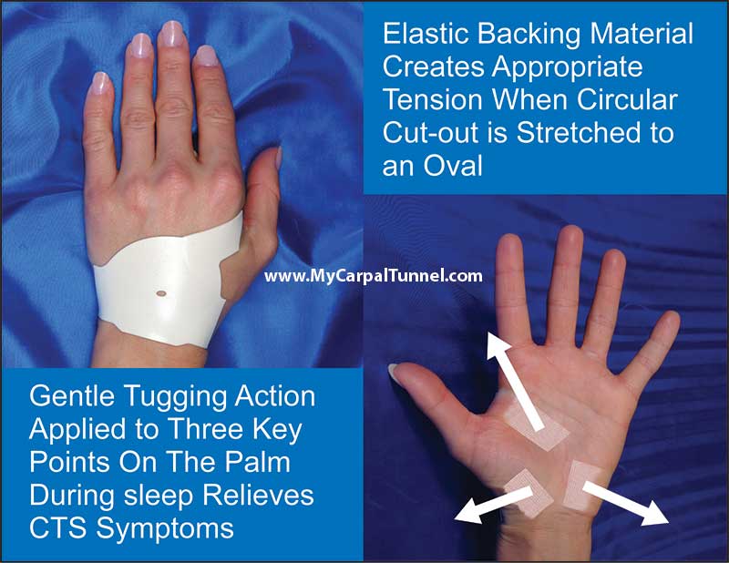 Carpal Tunnel Hand Braces: An Overview