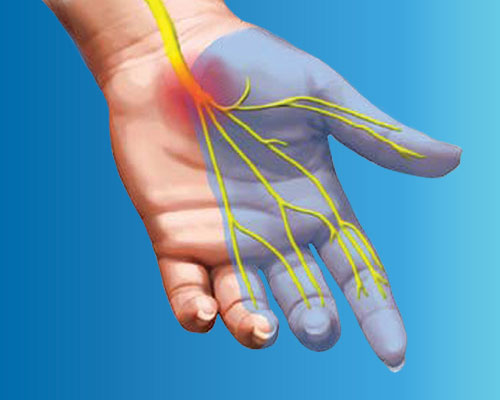 Carpal Tunnel Rarely Causes Permanent Nerve Damage