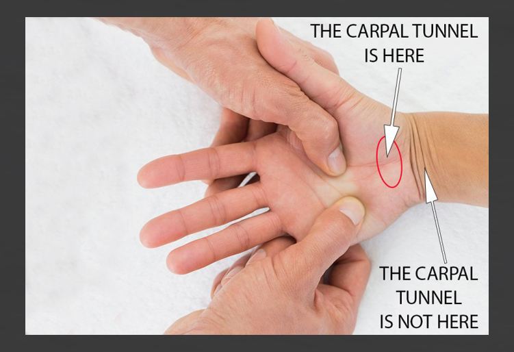 Where is the Carpal Tunnel Anatomically? In the Hand or in the Wrist ...