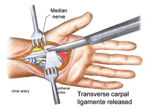 More Invasive Carpal Tunnel Treatment