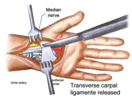 Carpal Tunnel Surgery Video