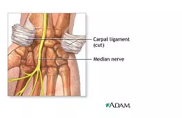 Carpal Tunnel Anatomy and Treatment