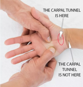 Carpal Tunnel Solution